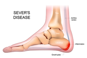 Managing Sever’s Disease