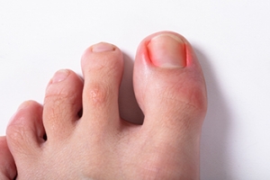 Why Do Ingrown Toenails Develop?