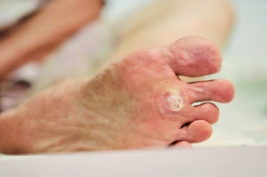 Plantar Warts Can Cause Pain