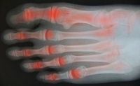 Musculoskeletal Problems in Rheumatoid Arthritis