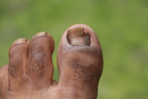 Understanding Toenail Fungus