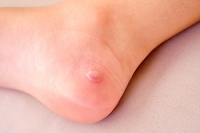 Causes and Symptoms of Foot Blisters