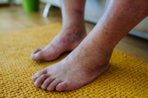 How Diabetes Can Affect the Feet