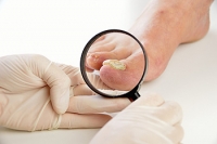 How Can a Fungal Toenail Develop?