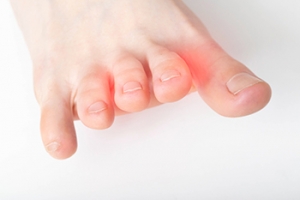 The Odd Sensation of a Morton’s Neuroma