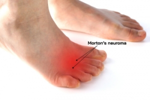 Surgery for Morton&#039;s Neuroma