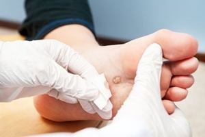 How Plantar Warts Appear