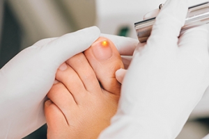 Laser Treatment For Fungal Toenails