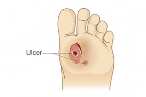 Kidney Disease and Foot Ulcers