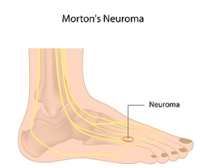 Who is Prone to Developing Morton’s Neuroma?