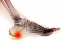 Reasons a Heel Spur Can Develop
